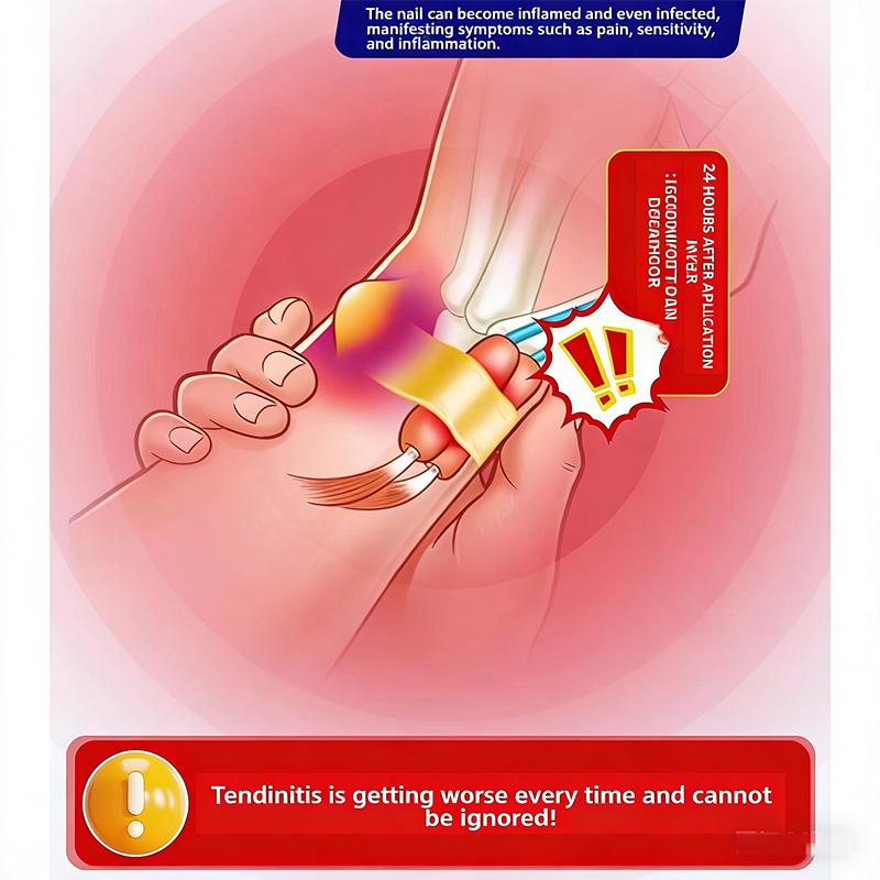 Тендинит Облегчение боли в суставах: При дискомфорте в большом пальце