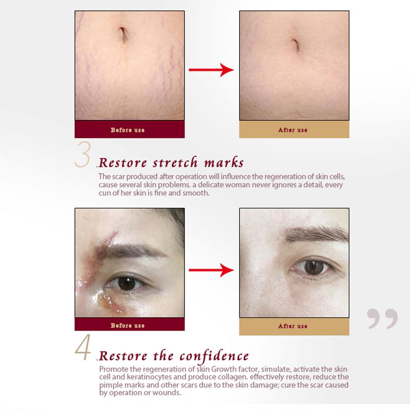 ARTISCARE Гель для удаления шрамов и прыщей 30 г TCM Лечение черных точек Уход за кожей