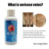 Foot Leg Veins Plaster Leg Spray Spray Swelling Healthy Professional Spray
