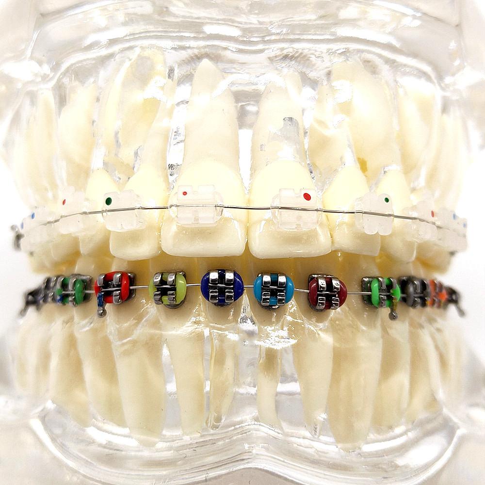 1 шт., стоматологическая ортодонтическая модель, связь с пациентом, 2 вида брекетов с дугами, лигатуры, керамический брекет, металлический краевой брекет