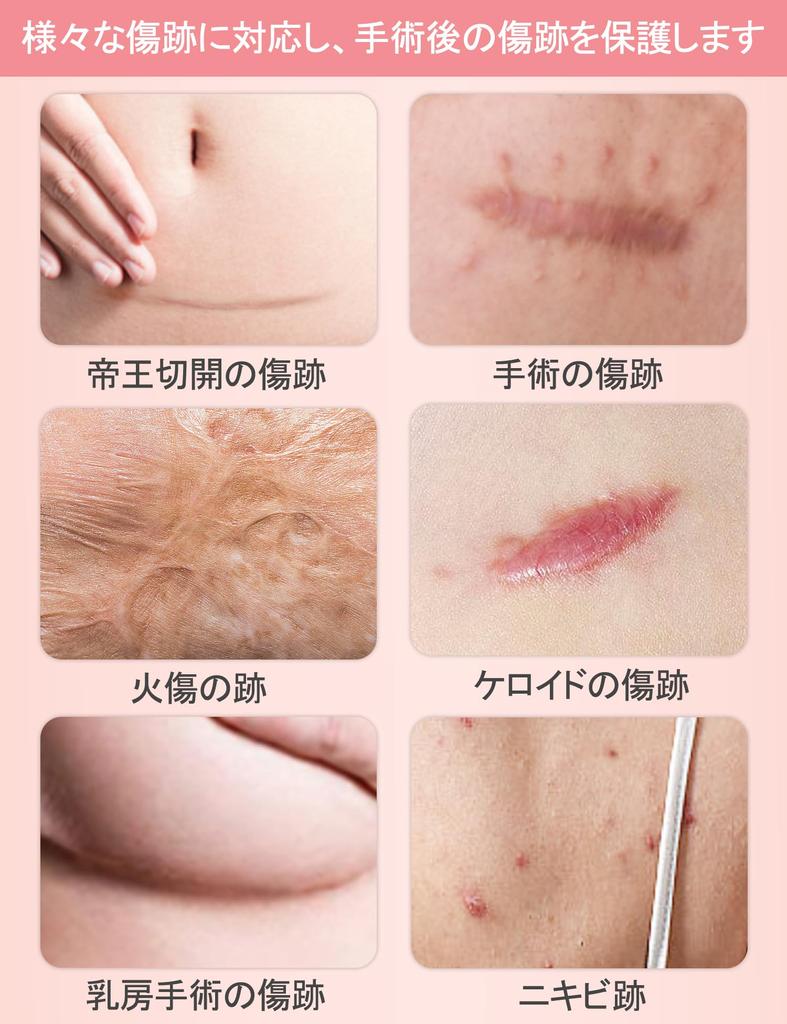 Лента для ухода за шрамами после кесарева сечения, келоидных шрамов, гипоаллергенная и нежная для кожи, для шрамов, силиконовая, настраиваемая, рекомендована дерматологами,