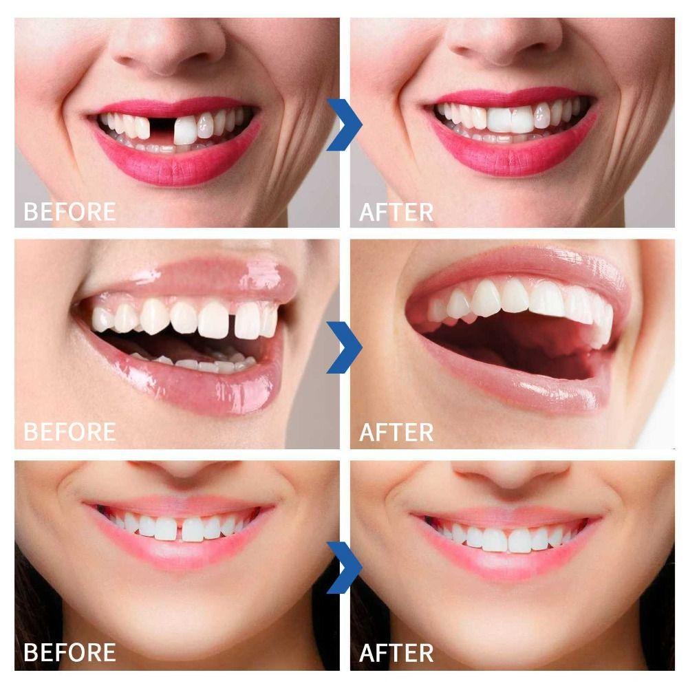 Мгновенный силиконовый набор для перебазировки зубных протезов Исправьте свою улыбку Силиконовый набор для зубных протезов Виниры Зубы