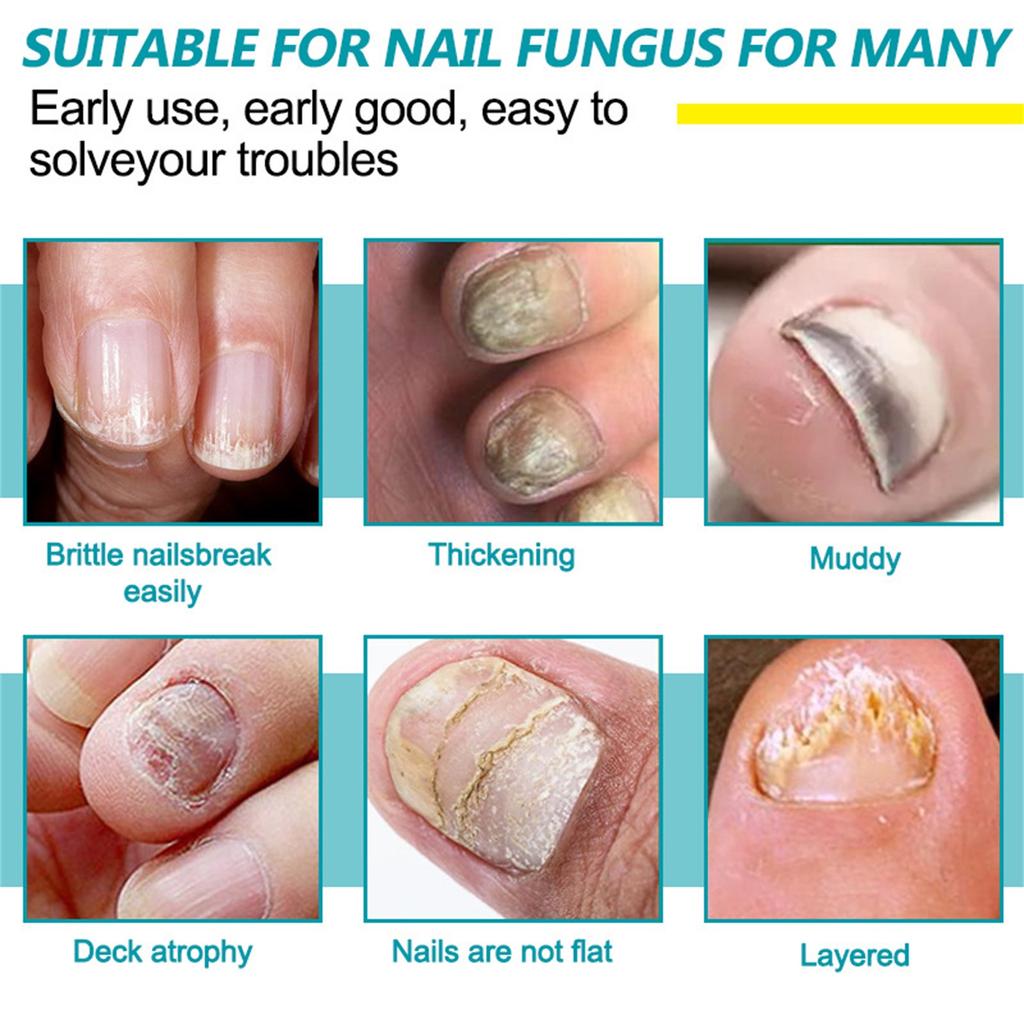 Уход за ногтями с грибком, быстродействующая жидкость для ухода за ногтями от грибка под ногтями и вокруг них, восстанавливает здоровый вид ногтей 5 мл