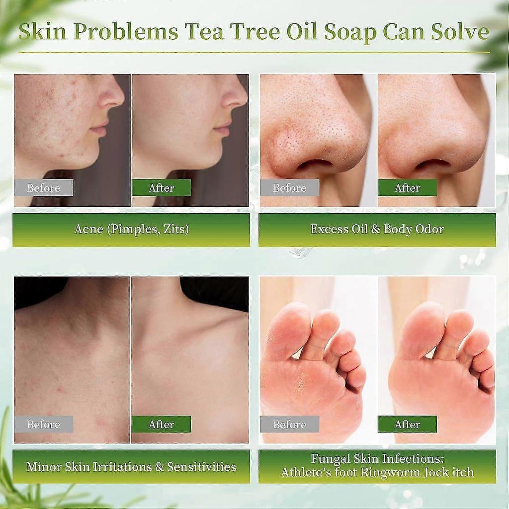 Tea Tree Oil Antifungal Soap Bars - 3 Piece Pack for Face Body & Hand Care - Combats Acne, Relieves Fungal Skin Problems, Controls Oil, Clears Pores_1