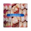 (a1) Strong Dental Cement for Teeth Repair, Cavity Filling & Restoration, Resin Tooth Repair Kit for Dental Restoration