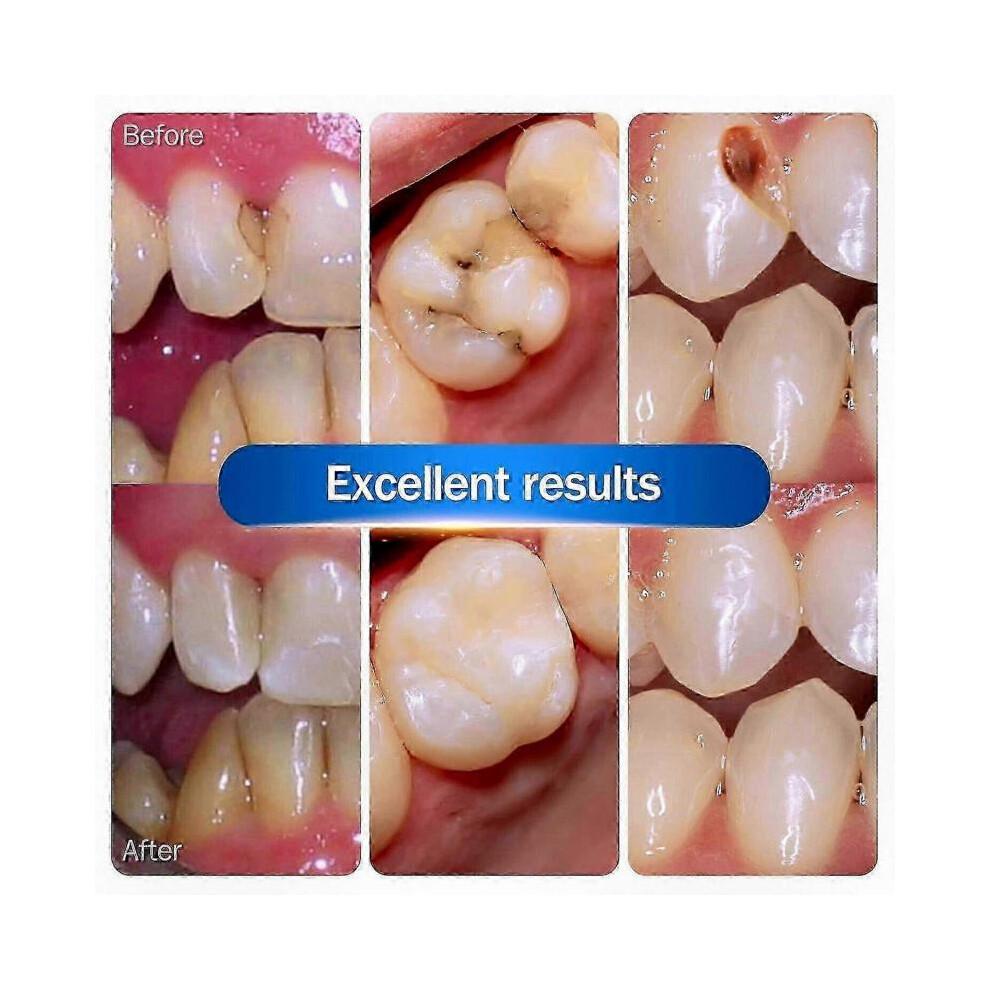 (a1) Strong Dental Cement for Teeth Repair, Cavity Filling & Restoration, Resin Tooth Repair Kit for Dental Restoration