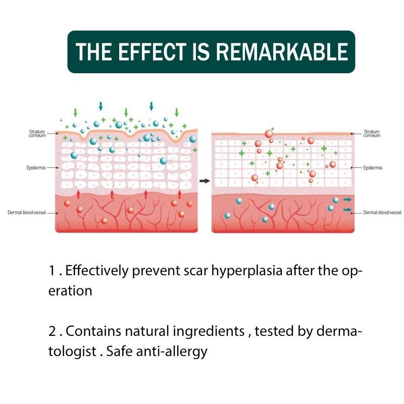 Eelhoe Silicone Scar Patch For Stretch Marks And Burn Scars Suitable For All Skin Types