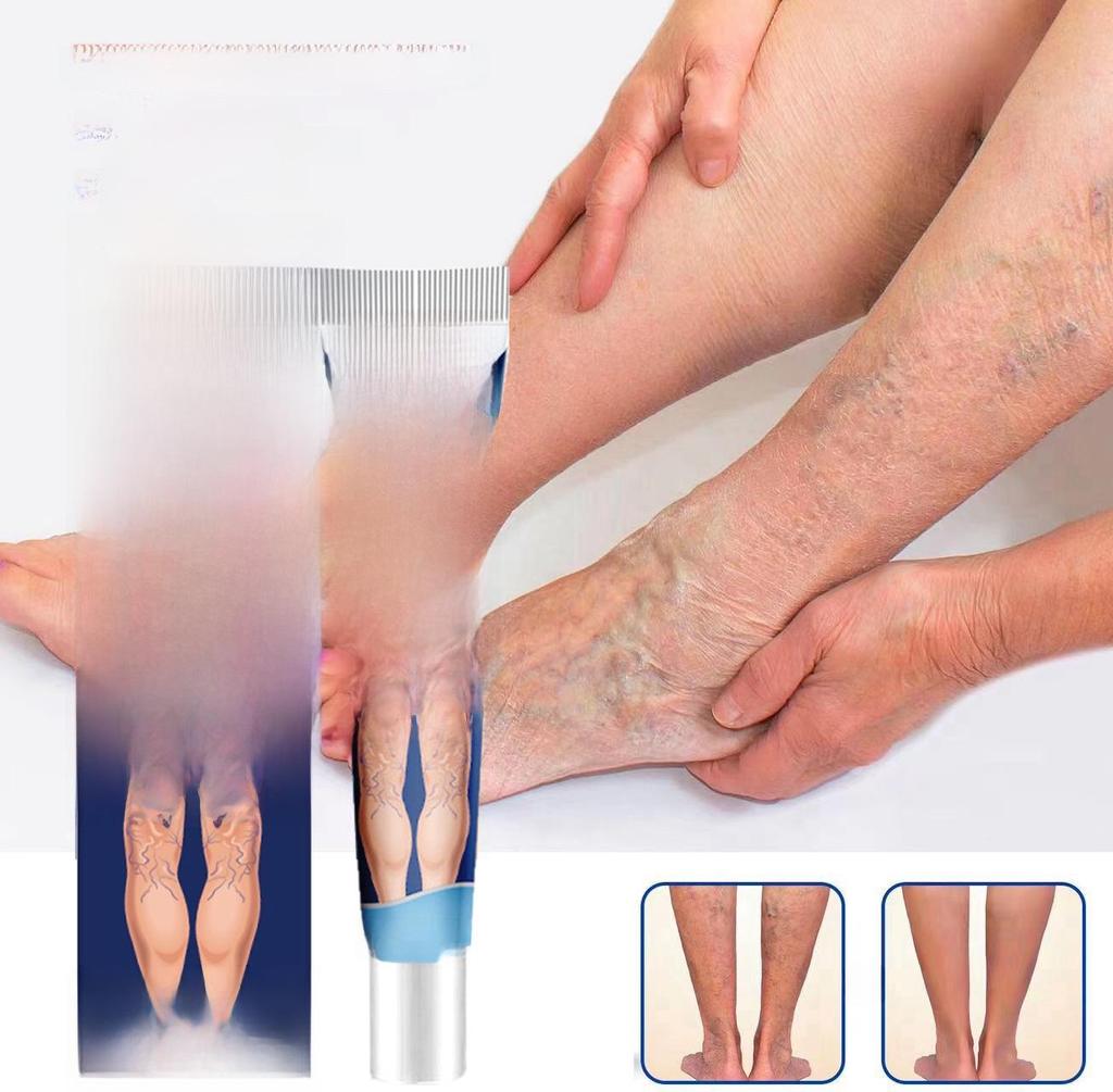 Крем SOL LORA Varicose Vein Repair Cream – снимает отеки ног и выпирающие вены