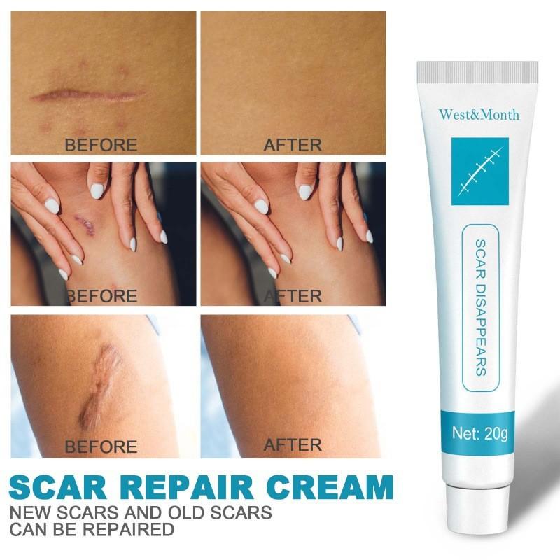 West Month Scar Repair Cream For Reducing Hypertrophic Scars And Pregnancy Marks