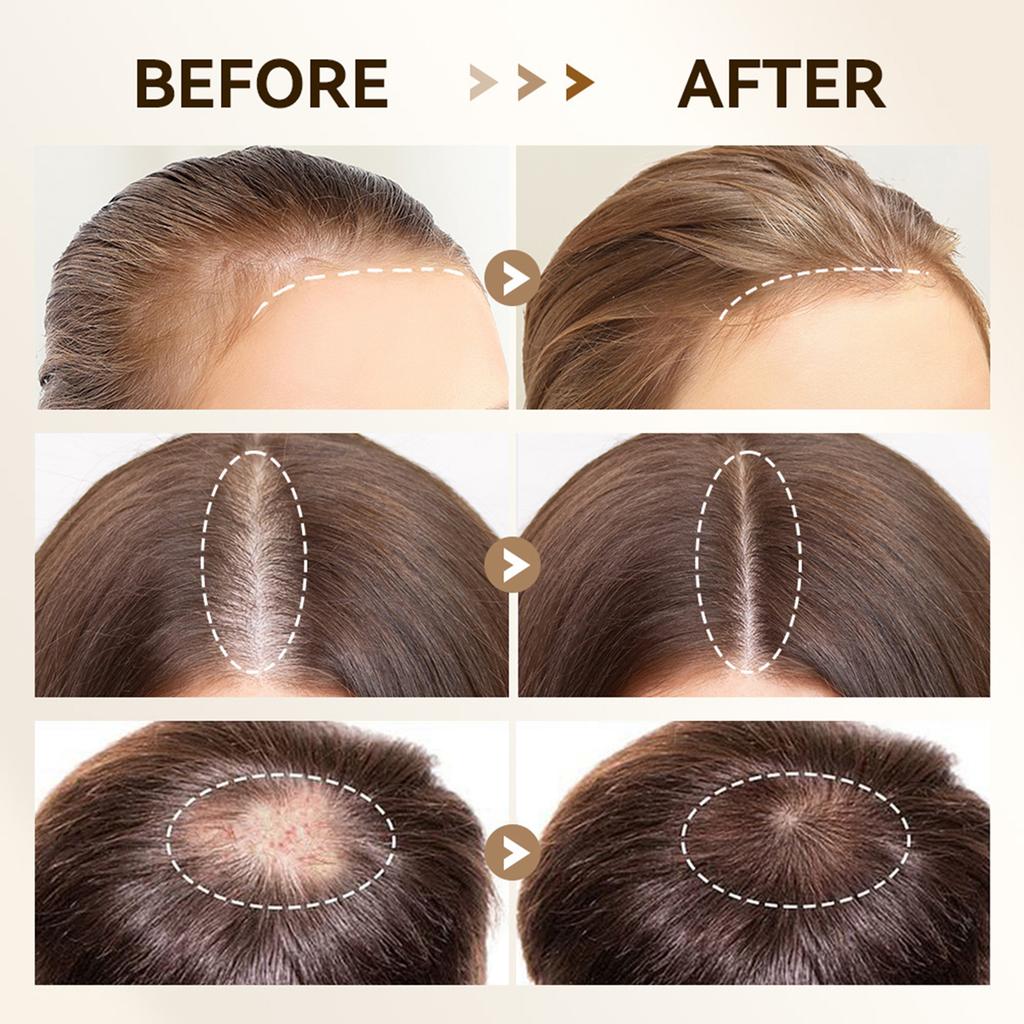 64-Needle Head Fit for Bio4 Microneedling Derma Pen, Microneedling Replacement Head,   Needle Depth (0-3.0mm), At-Home Scalp Care for Thinnin