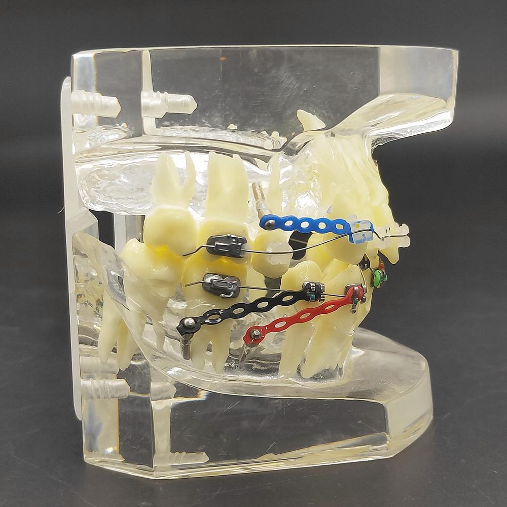 1 шт., прозрачная стоматологическая ортодонтическая модель прикуса с брекетами, буккальная трубка дуги для общения с пациентом