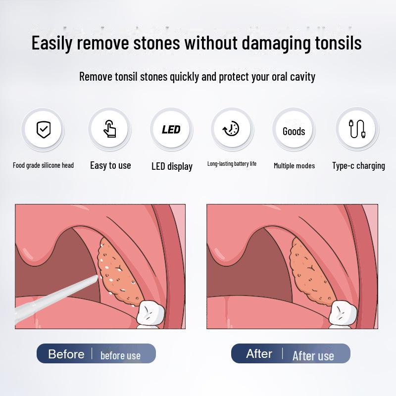 Электрический экстрактор камней из миндалин и очиститель полости рта