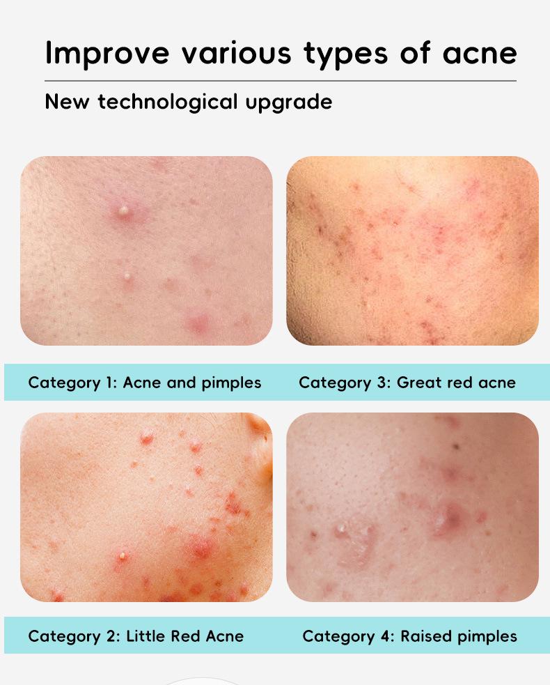 Portable Electronic Pimple Patch with Red/Blue Light Therapy for Rapid Acne Shrinking and Scar Fading