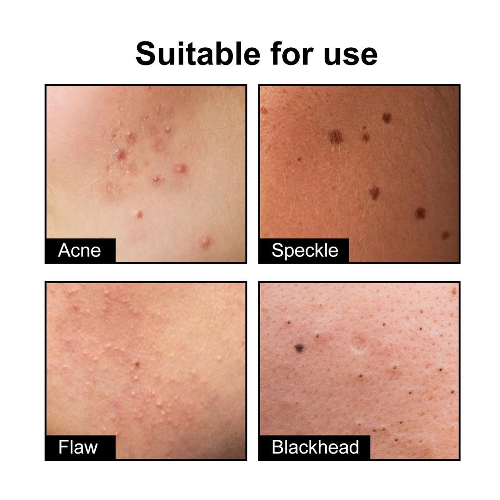 Cute Black Acne Patches For Face,Reduce Acne, Close Acne Marks, And Remove Blackheads(108 Count)