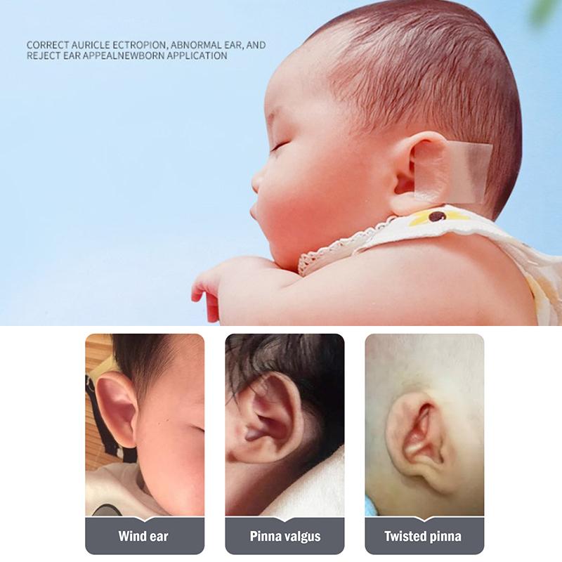 Auricle Valgus Correction Sticker Correction Sticker Silicone Sticker
