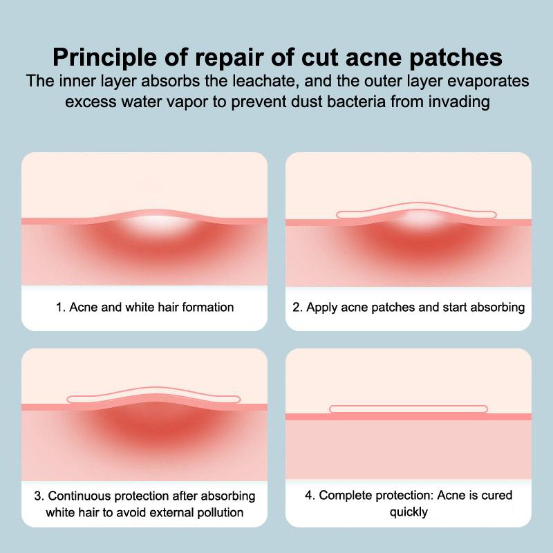 1 Набор Сверхтонкая Водонепроницаемая Мягкая Одноразовая Гидроколлоидная Повязка с Бортиком Пластырь для Раны Медицинская Гидроколлоидная Повязка