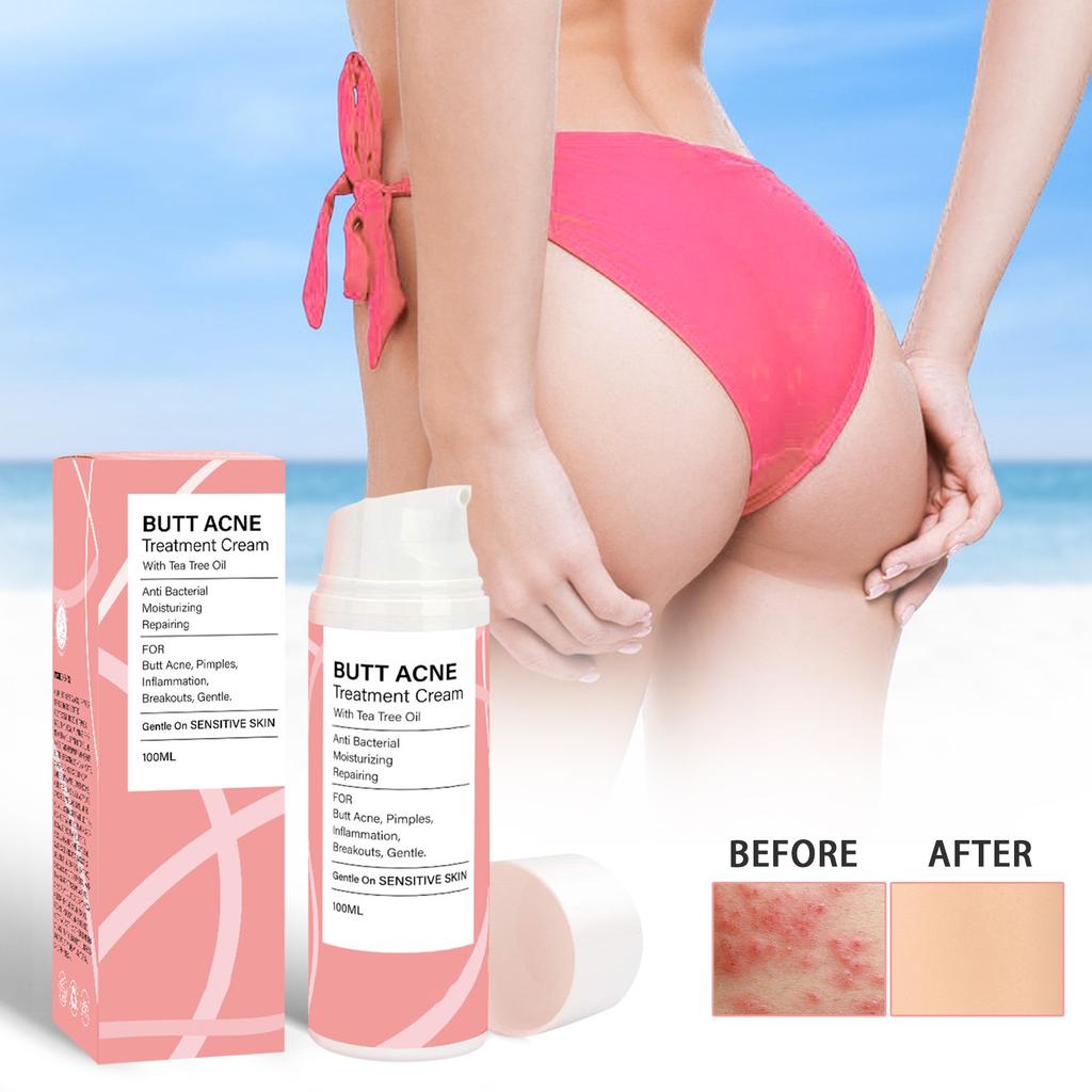 Крем для ухода за ягодицами от прыщей Эффективно устраняет фолликулит угревой сыпи, крем для ухода за ягодицами от прыщей Увлажняющий крем для ягодиц Уменьшает прыщи на теле