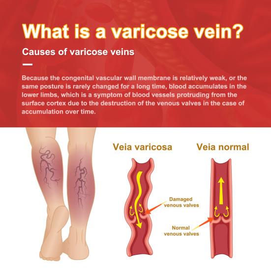 12Pcs/Bag Vessel Blockage Patch Moderate Effective Non-irritating Delicate Texture Eco-friendly Health Care Tool Portable Varicose Relief Care Patch