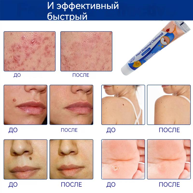 Мазь для удаления родинок ZB с коллагеном для ежедневного ухода за кожей и растворения бородавок