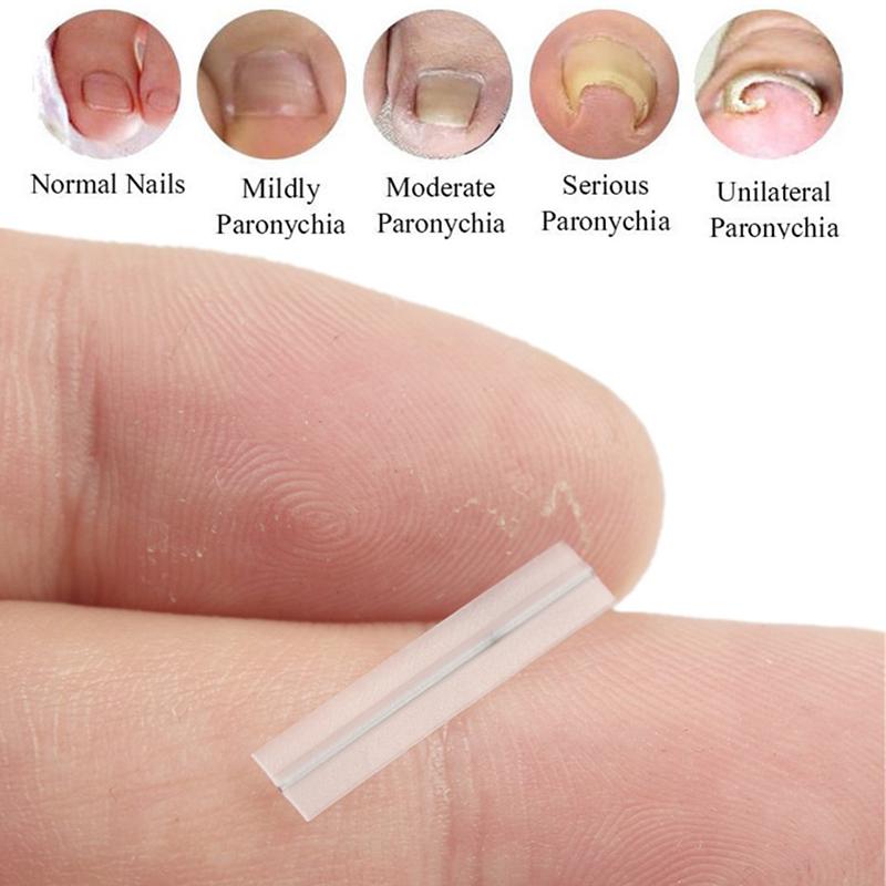 Инструмент для коррекции вросшего ногтя на ноге Выпрямляющая клипса Скоба Лечение вросшего ногтя Эластичная наклейка-пластырь Инструмент для педикюра