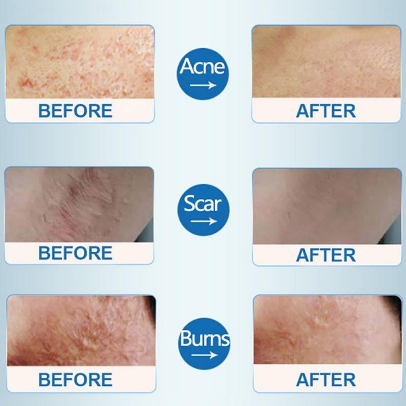 Пластырь Натуральное Змеиное Масло Крем для восстановления шрамов от прыщей Шрам Духовой ремонт Шрам от ожогов Растягивающийся анти-лавандовый