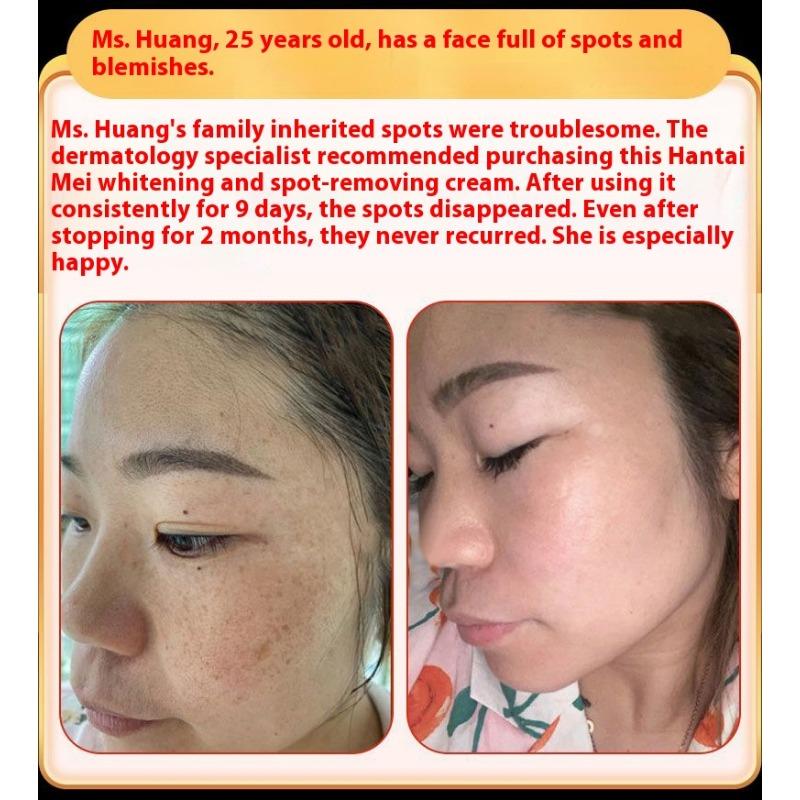 Whitening and Freckle Removing Cream Face Cream Lightening and Removing Spotles Sunburn Brightening Skin Color