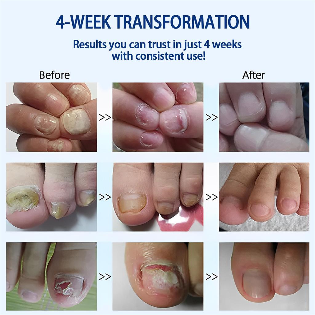 Plant Nail Care Solution 10ml Foot Care And Maintenance Nail Polish Nail Care Solution 10ml