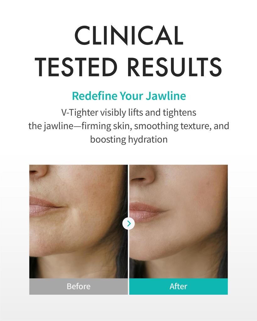 REJURAN Perfect Mask x 4 Оригинальная коллагеновая листовая маска для упругости и обвисания лица [Официально] V-Titer (листы 20 г) c-PDRN