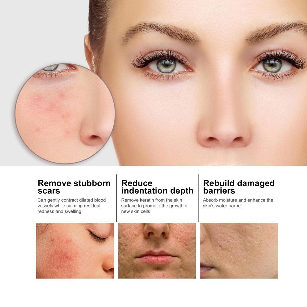 Эссенция для лица с ниацином удаляет следы от прыщей, увлажняет, сужает поры, отбеливает кожу и украшает ее.