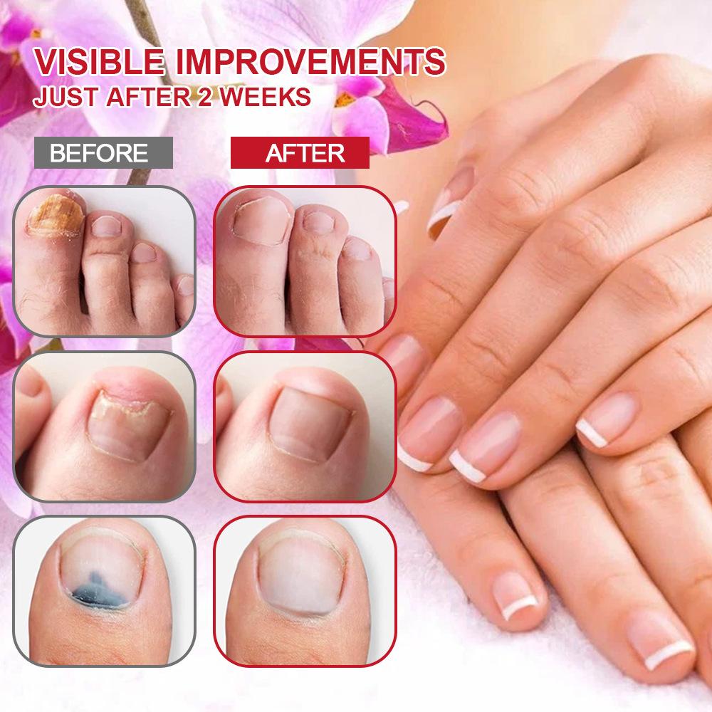 Средство для лечения грибка ногтей, поврежденных и изменивших цвет ногтей 4 мл