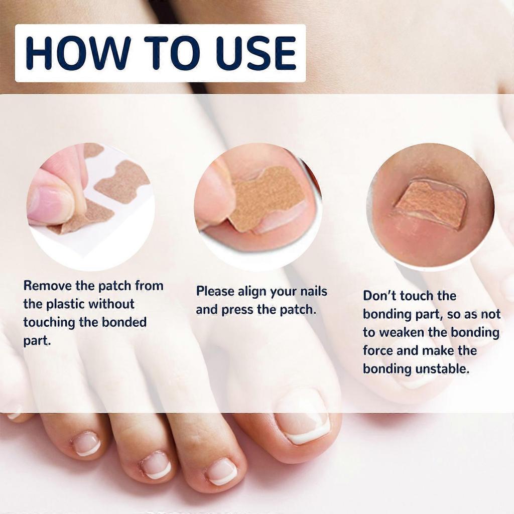 Toenail Correction Patch,  Ingrown Toenails Treatment Sticker - Toe Correction Sticker