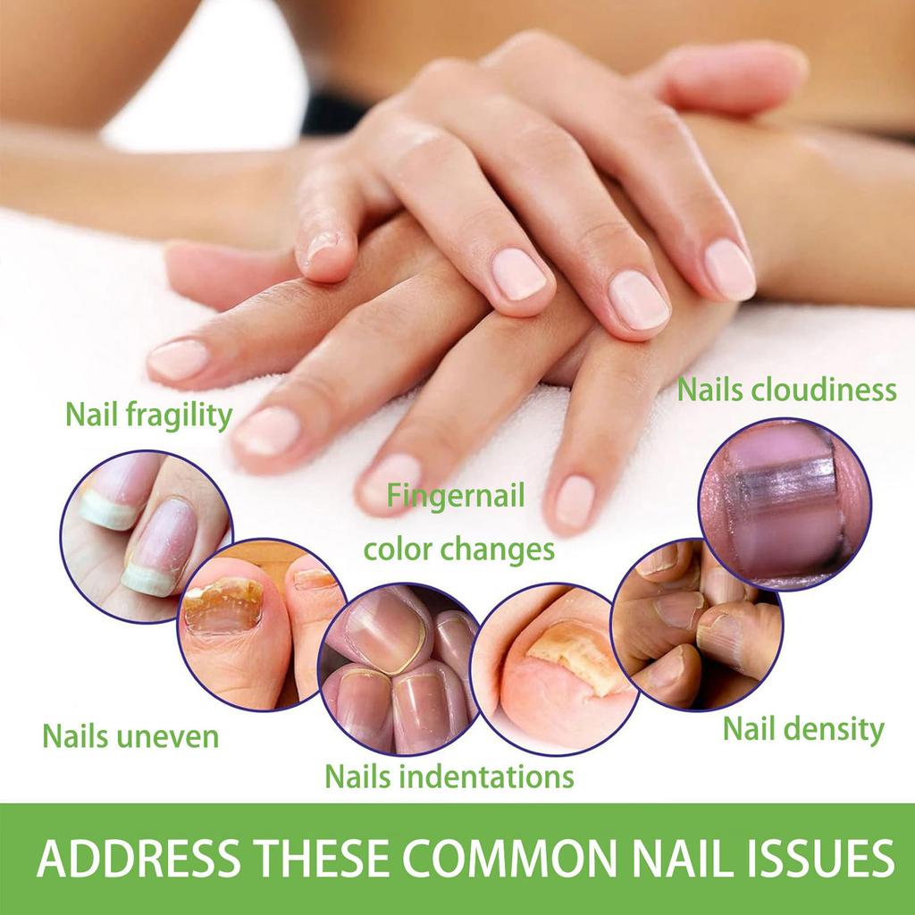 Руки и ноги Мягкие ногти Инкрустированные ногти Утолщение Яркие борозды для ногтей Серые патчи для ухода за ногтями