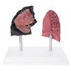 Анатомически точная модель легких курильщика для сравнения со здоровыми легкими, изготовленная из ПВХ, для клинического образования