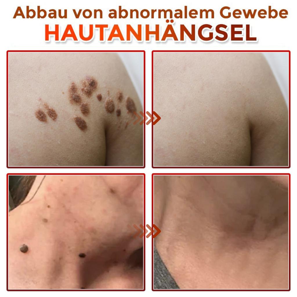 Удаление кожного невуса Микроигольный пластырь для уменьшения плоских невусов Уход за лицом и глазами.