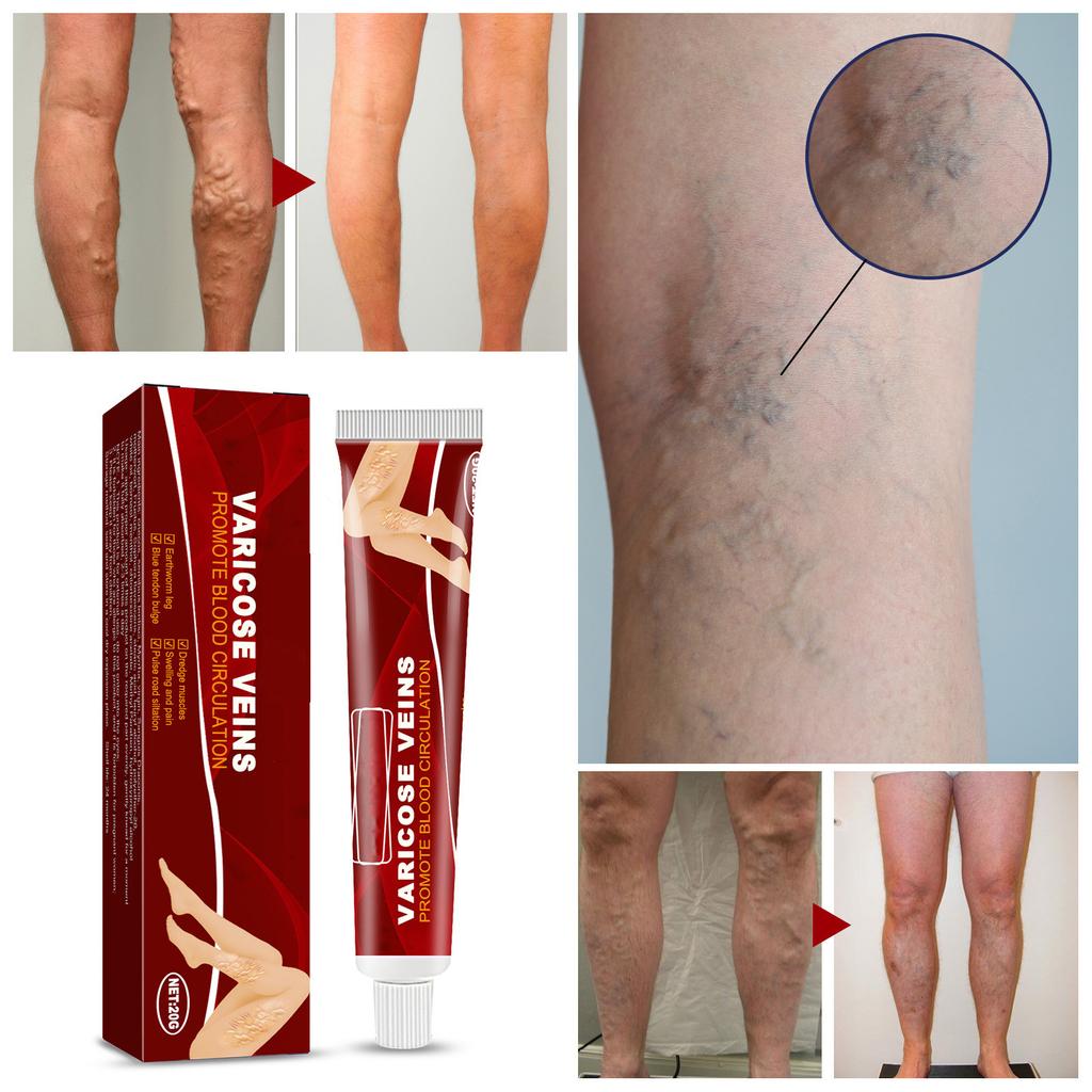 Паста от варикозного расширения вен, паста от варикозного расширения вен, варикозное расширение вен и сосудистые звездочки облегчают состояние ног, улучшают кровообращение