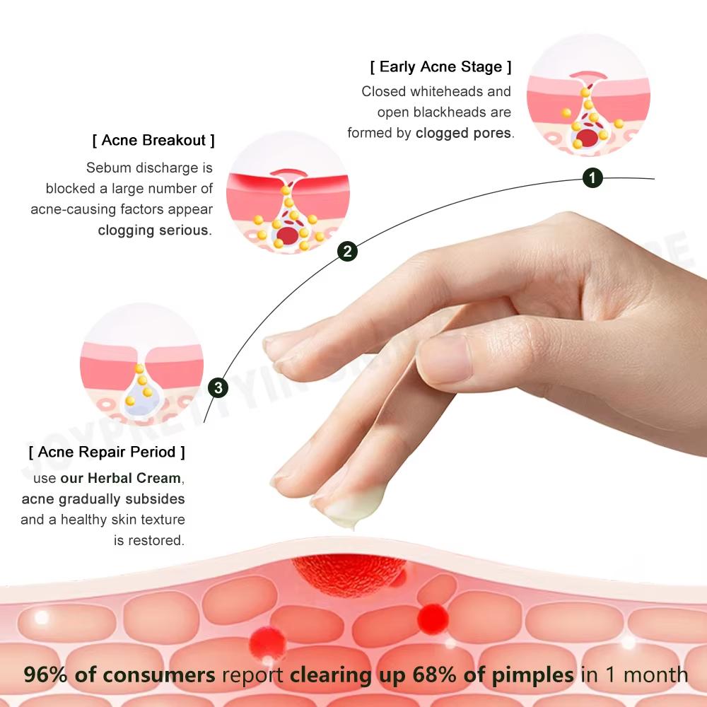 JoyPretty Herbal Acne Face Cream Body Pimple Treatment Oil Control Увлажняющие кремы для лица Средства по уходу за кожей Красота