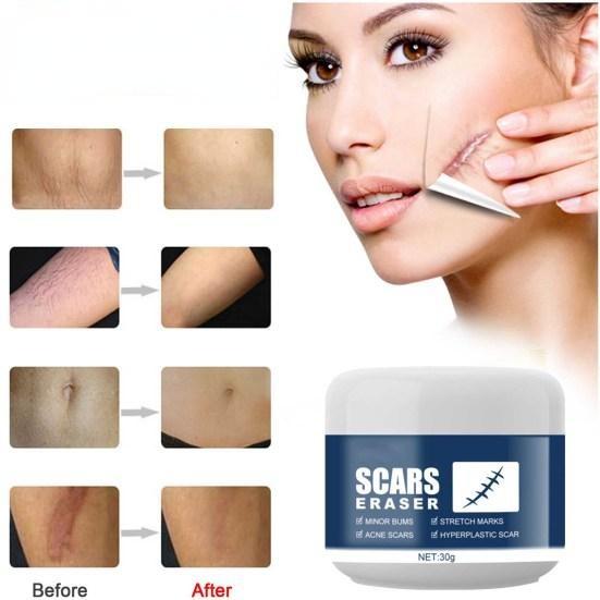 Не раздражающий восстанавливающий синтетический крем для удаления шрамов