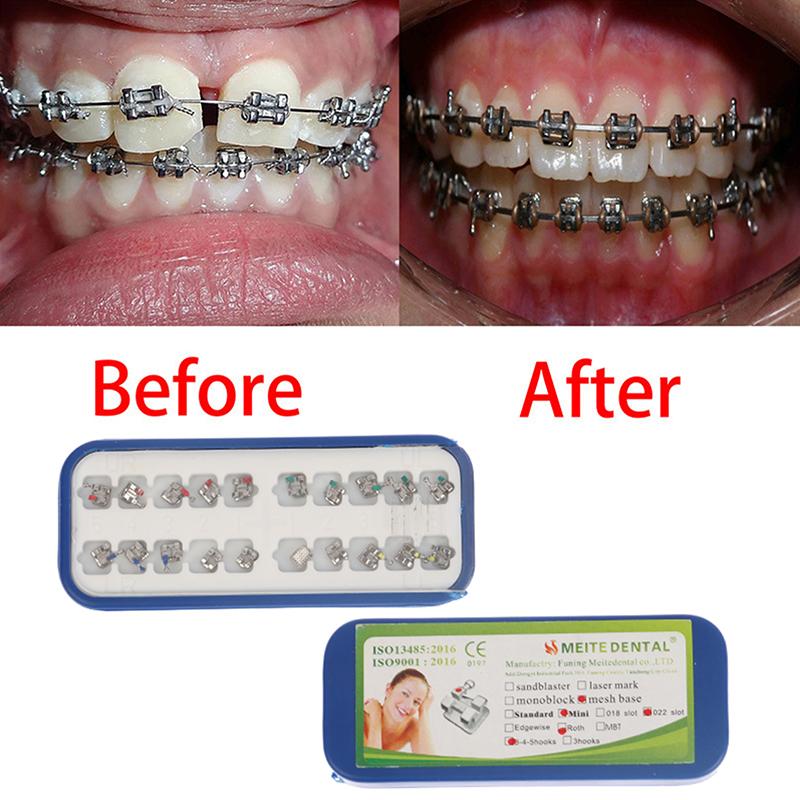 Высококачественные стоматологические брекеты Материал пассивные самолигирующие брекеты Mbt/Roth 022 345 Крючки