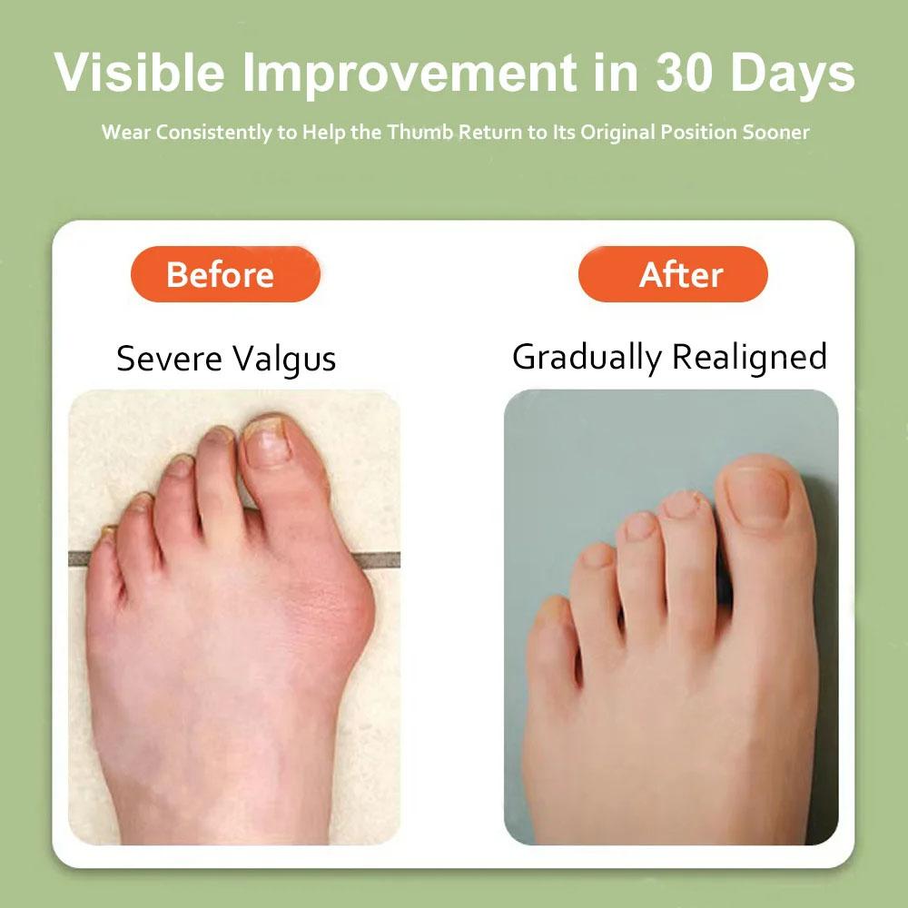 Вибрационный массажер Корректор косточки большого пальца стопы Унисекс Стопа Вальгусные скобы Разделитель пальцев ног Корректор пальцев ног Выпрямитель Регулируемый