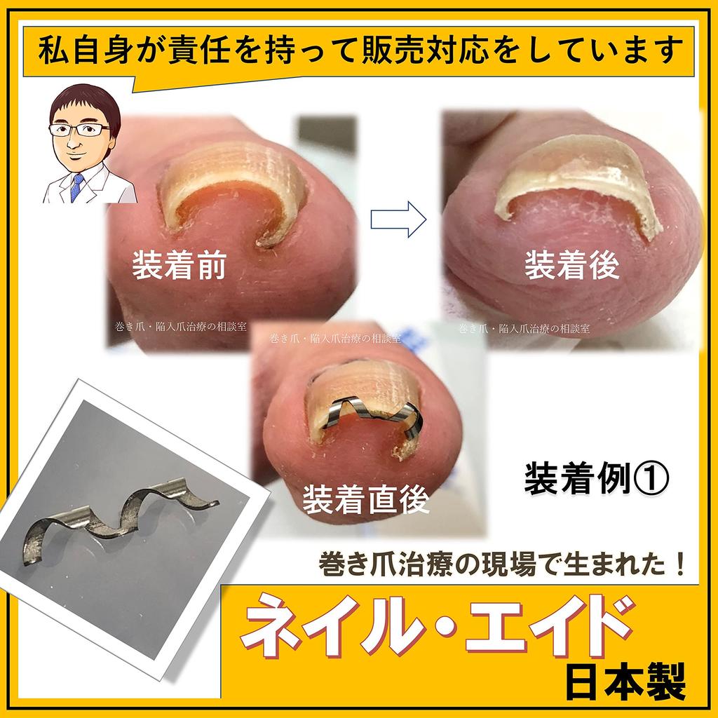 Nail Aid 16 мм Коррекция вросшего ногтя Сделай сам Проволочный зажим