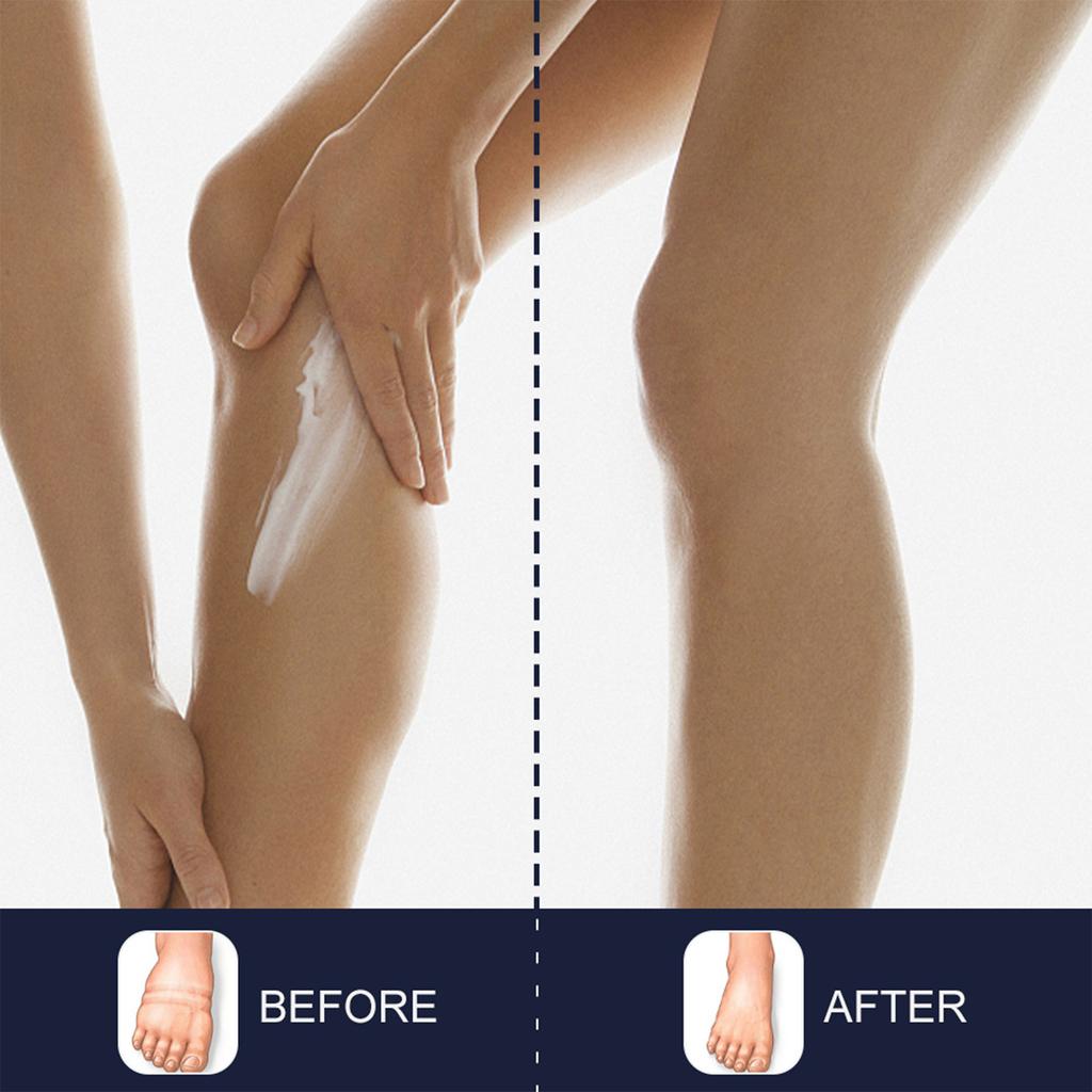 Anti-edema Cream Leg Swelling Edema Cream Arm Calf Foot Massage Health Care Plaster