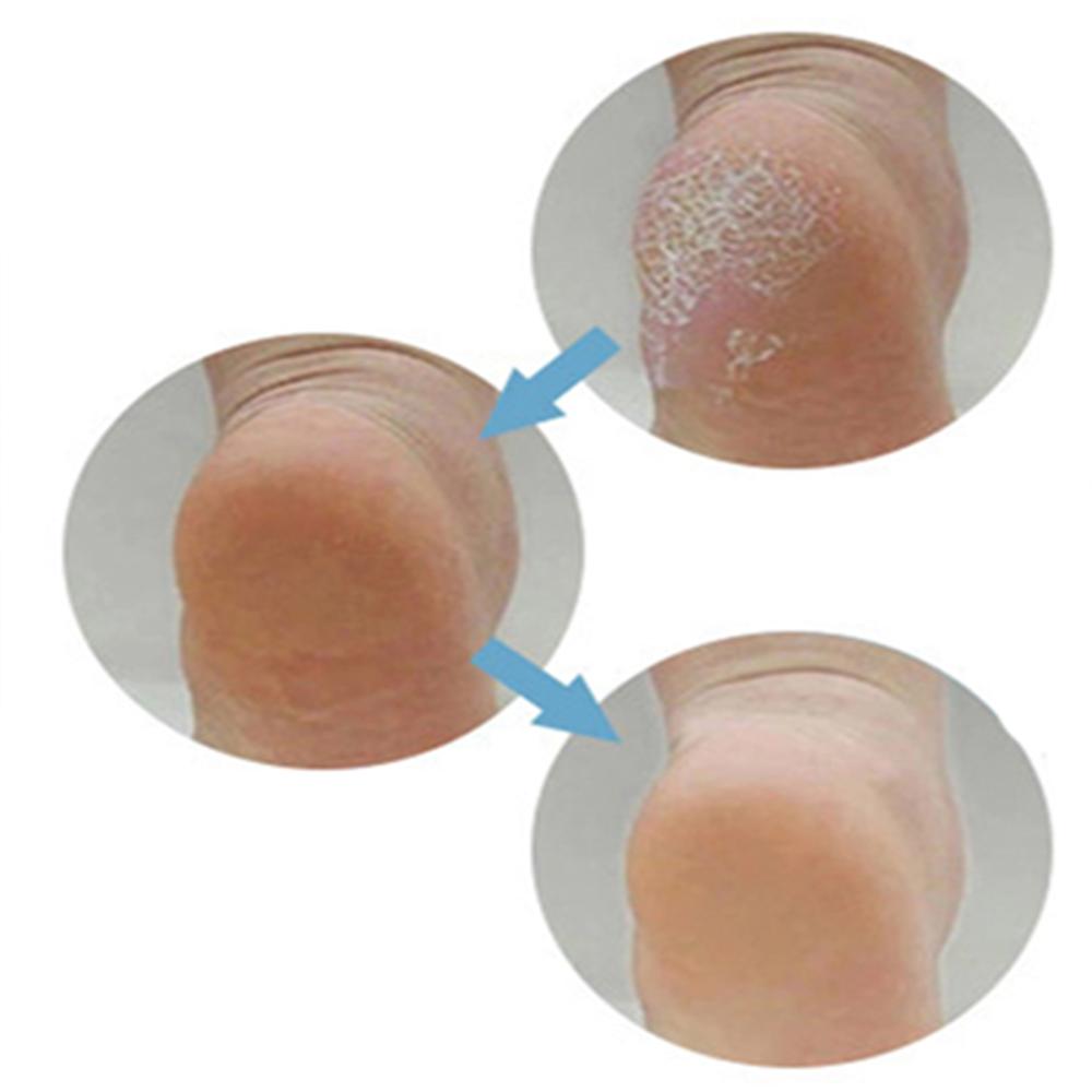 Remover Foot Care Exfoliating Foot Rasp Hard Dead Skin Remover Pedicure File File Cuticle Cleaner