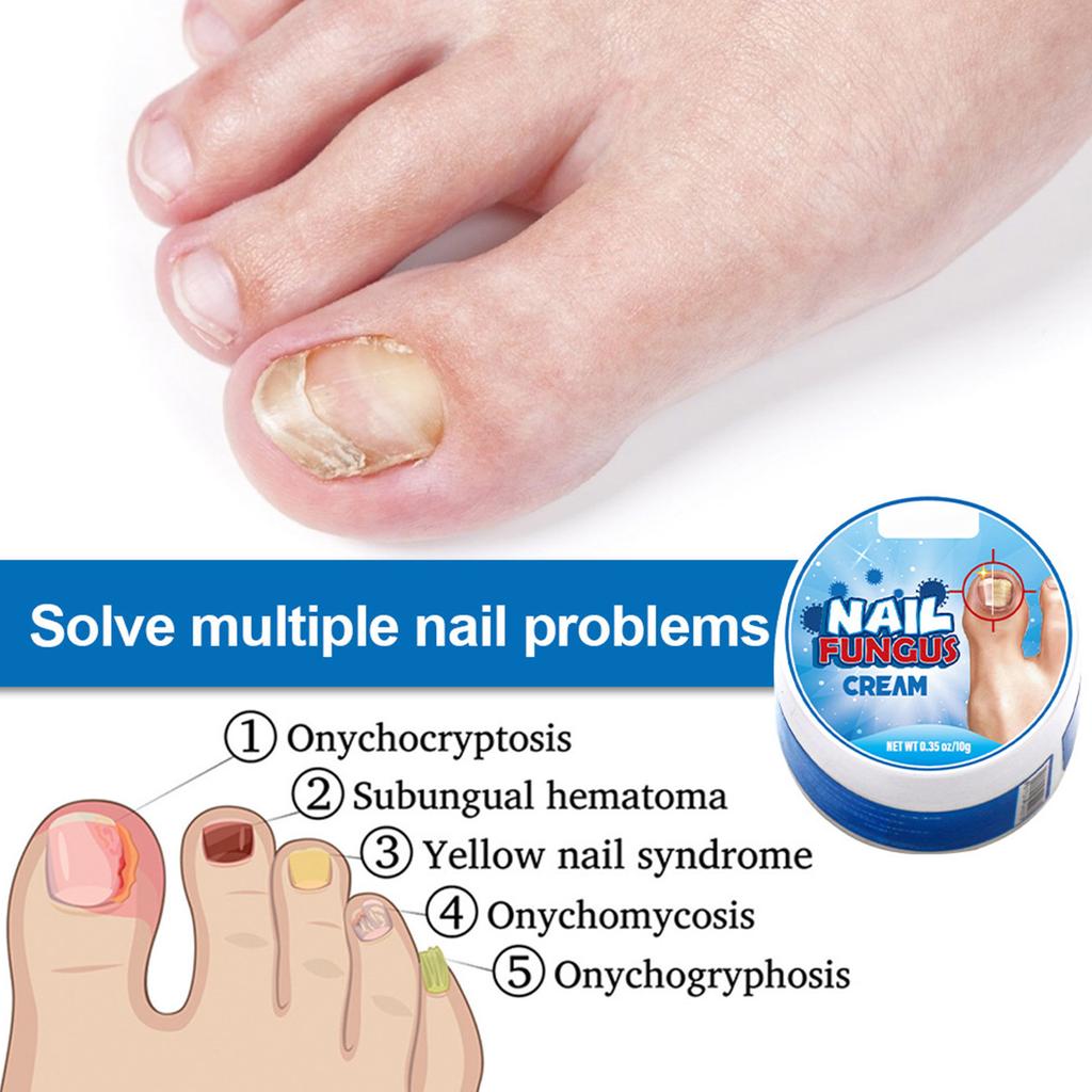 Plaster New Bright Nail Plaster Relieves Onychomycosis And Nail Care