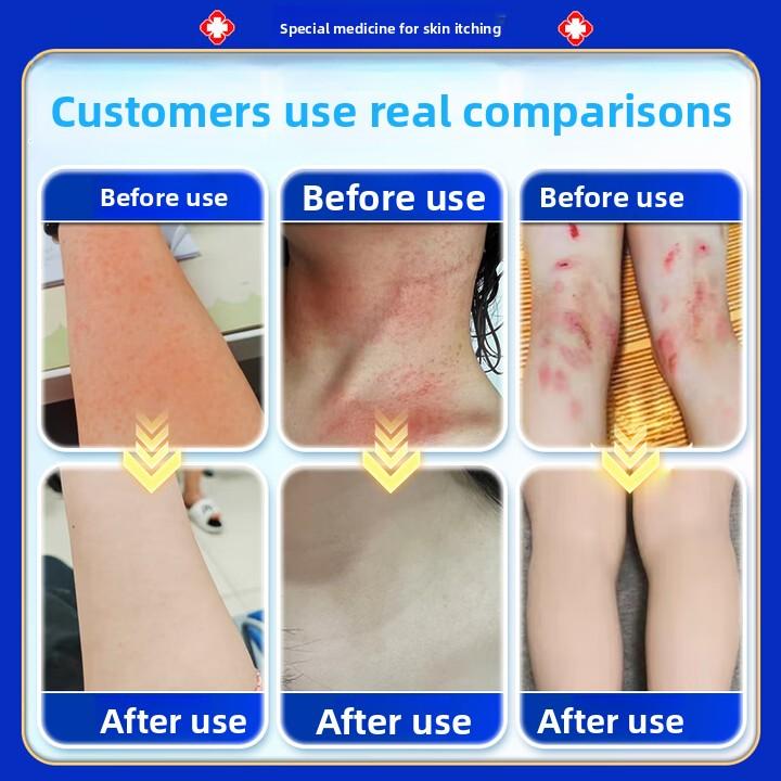 50 г Крем от экземы и грибка, Быстрое облегчение зуда при дерматите и кожных аллергиях, Антисептическая формула