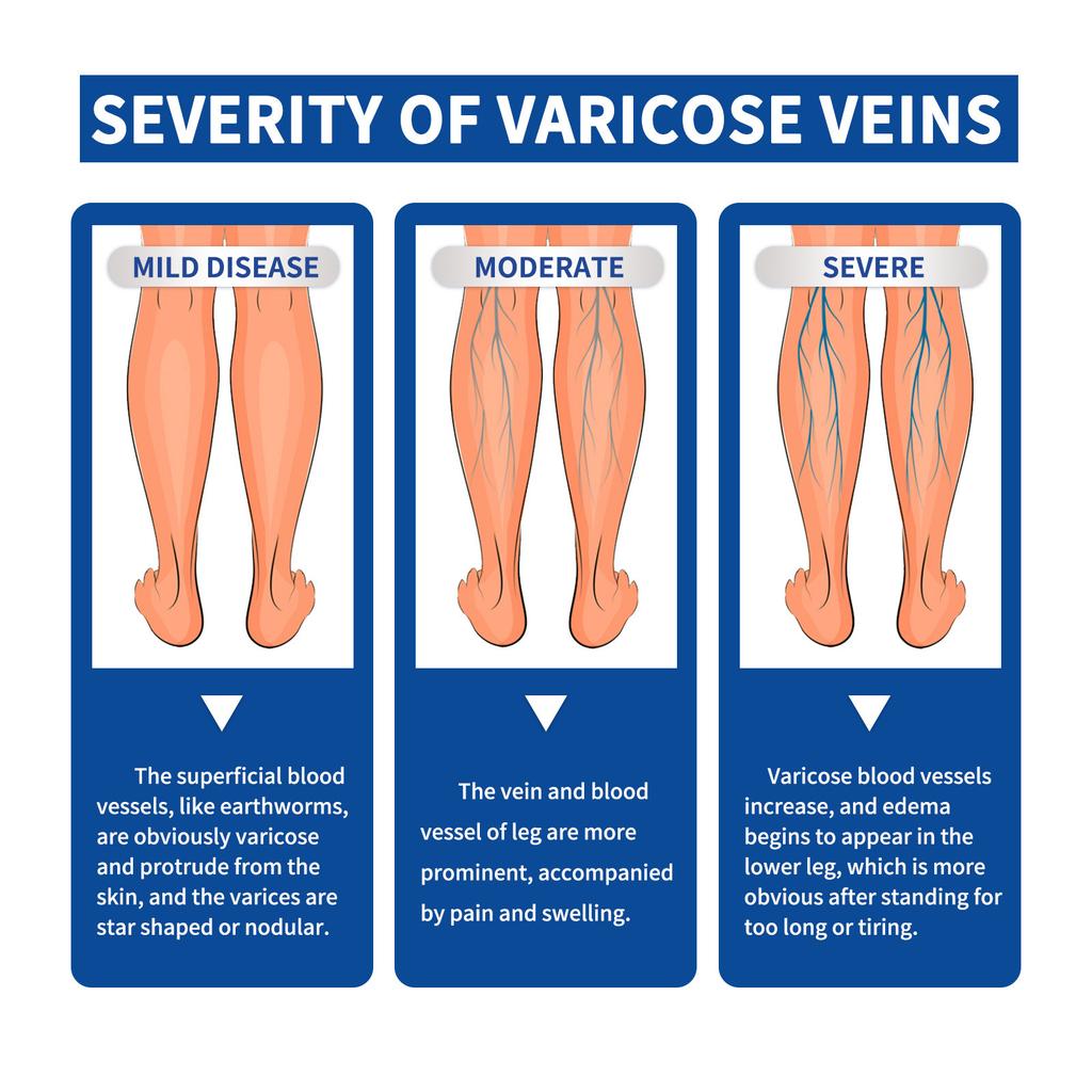 Varicose and Spider Veins Ease for Legs, Improve Blood Circulatio