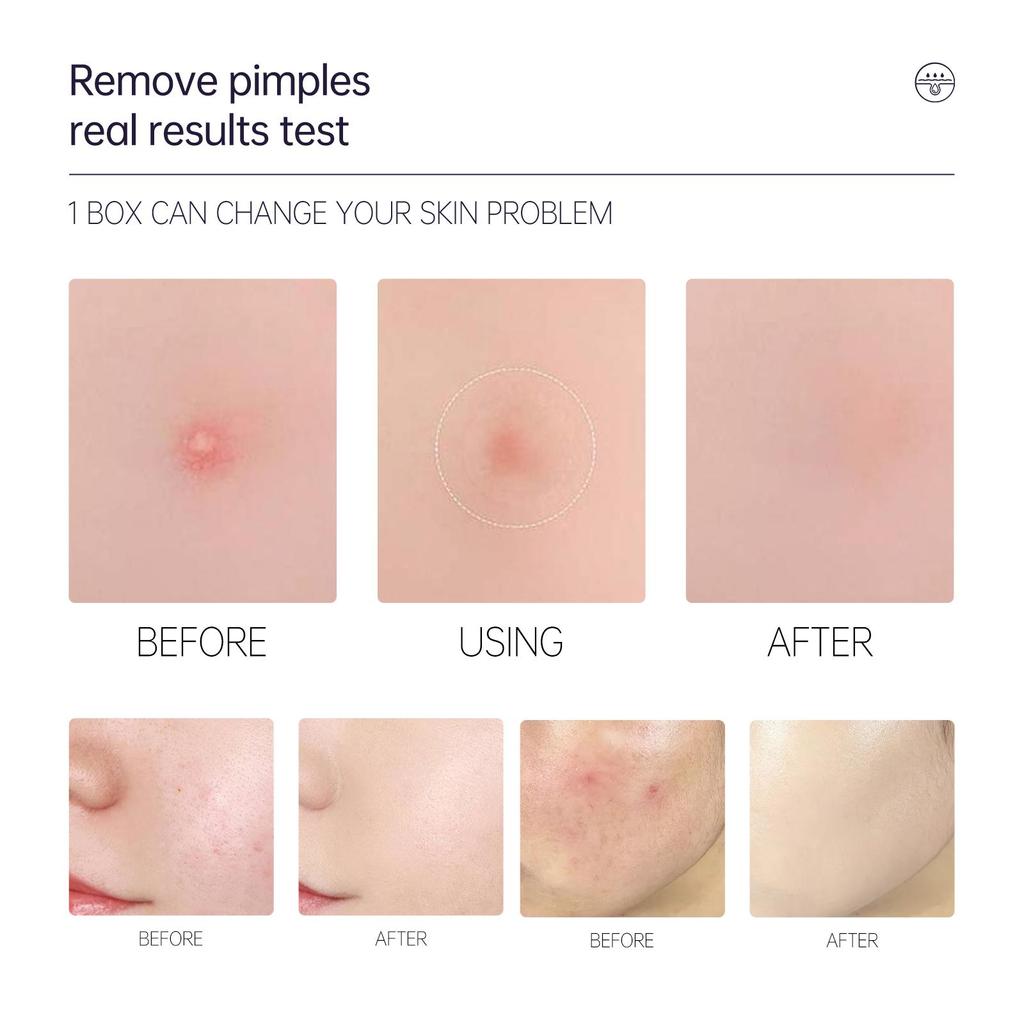 AUQUEST Средство от прыщей на лице, невидимый пластырь от прыщей