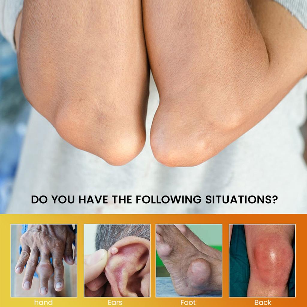 Крем для снятия боли, крем для снятия отечности суставов, крем для снятия отечности больших пальцев ног при подагре