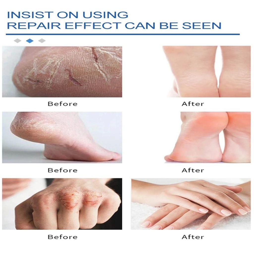 Foot Moisturizing Cream Is Rich In Plants and Can Be Used Flexibly for Dry, Cracked, and Rough Skin. Foot Moisturizing Cream