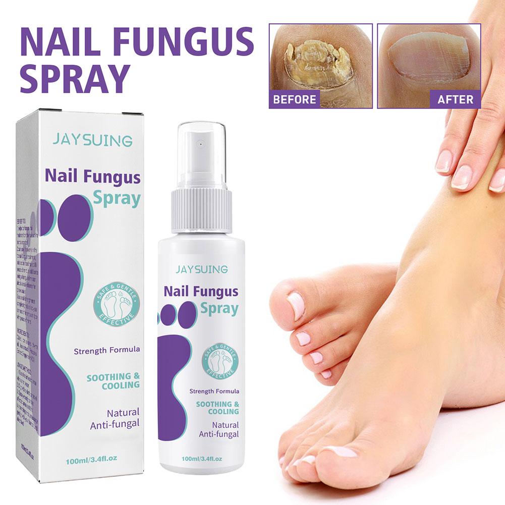 1/3/5PCS Nail Fungus Spray Reduce Beriberi Deodorize Remove Onychomycosis Paronychia Deeply Mild Cleansing Nail Care Spray