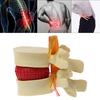 Anatomical Spine Lumbar Disc Herniation Anatomy Medical Teaching Tool
